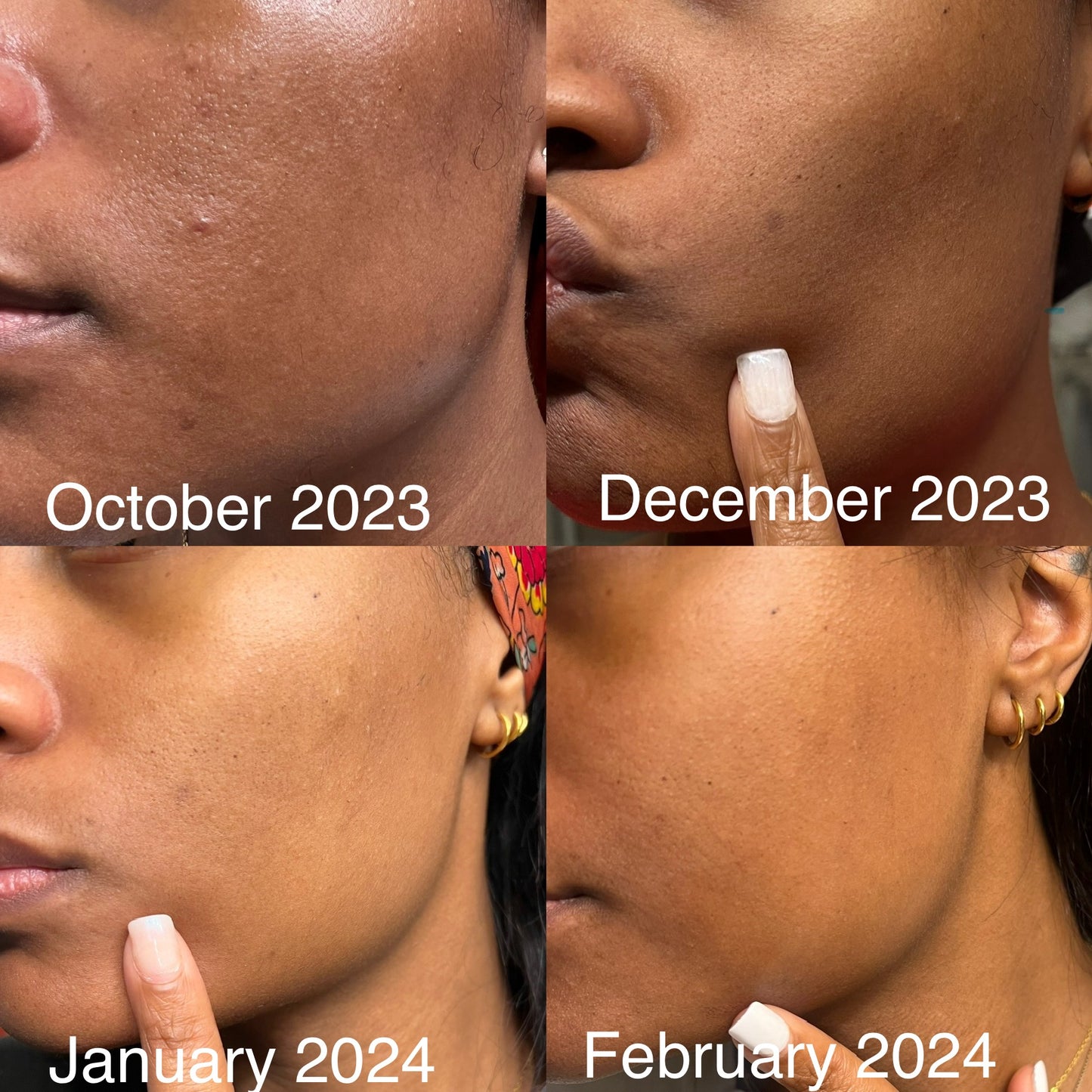 Dark Spot Eraser Moisturizer